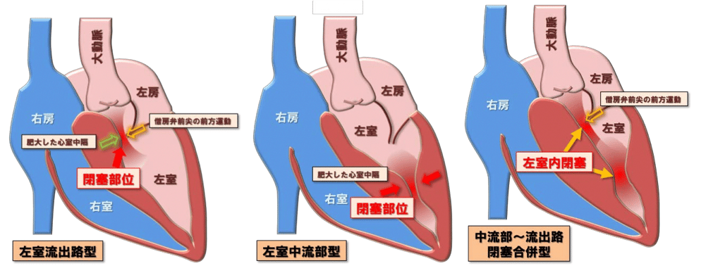 肥大型心筋症について - Genspark