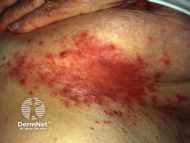 Candidal intertrigo close-up showing red moist skin with satellite papules