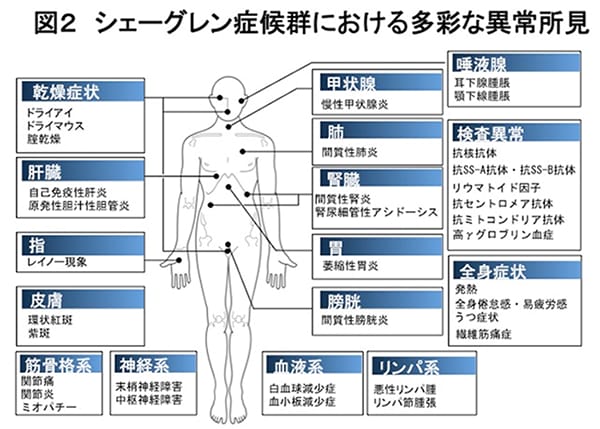 シェーグレン症候群の治療をする場合、医療費の補助はありますか