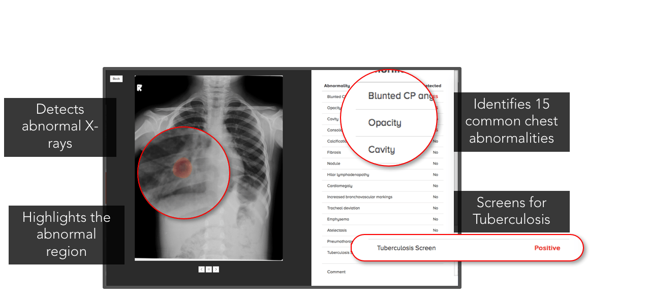 TB Screening with AI